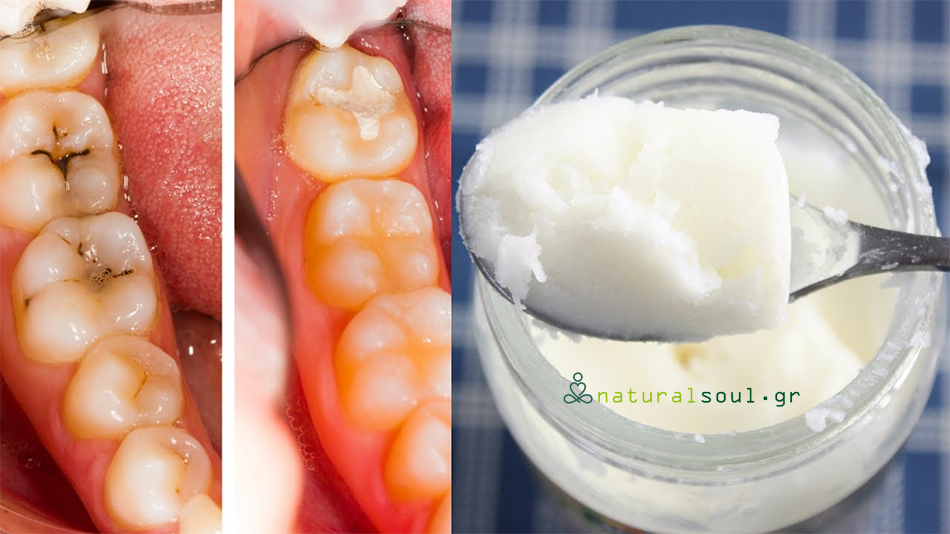 Πώς να Θεραπεύσουμε τις Οδοντικές Κοιλότητες (τρύπες) στα Δόντια και να Καταπολεμήσουμε την Τερηδόνα.